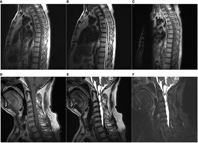 Primary cervicothoracic melanoma of spinal cord: a case report and literature review